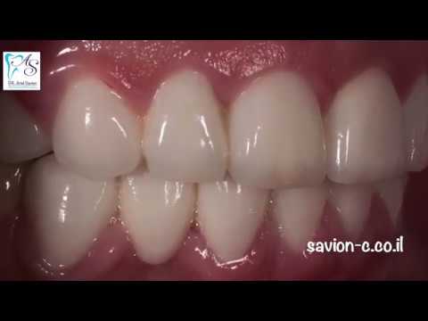 כתרי זירקוניה ועיצוב החיוך - ד״ר אריאל סביון - רופא שיניים בראשל״צ