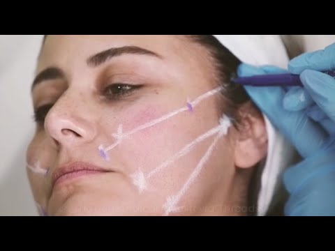        شد الوجه الغير جراحي بواسطة الخيوط الممتصة