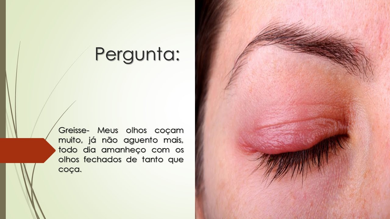 Meus olhos coçam muito | Todo dia amanheço com os olhos fechados de ...