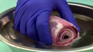 Reduction Fracture using Fiberglass