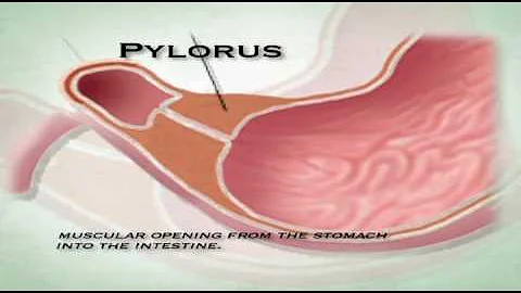 Lap Sleeve Surgery in Florida by Dr. Patrick Domko...