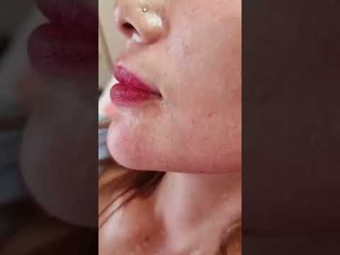 Nose Filler, Chin Filler, Lift Filler Before After