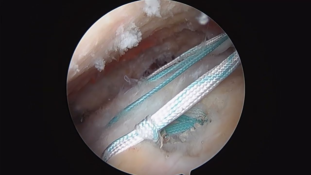 Full-thickness rotator cuff (supraspinatus) repair by Dr. Andrew Dold, MD