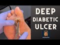 DEEP Diabetic Foot Ulcer podiatrist/foot and ankle specialist treats a foot ulcer