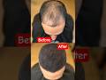 Reverse the Hairfall - the most effective technique #haircare #hairfall #hairgrowth #hairissues