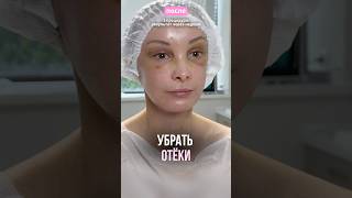 Результат реабилитации после пластической операции 👆 убрать синяки, отеки, уменьшить боль
