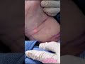 Renuvion(Jplasma) neck tightening done awake local anesthesia.If you don’t want a big scar2039184113