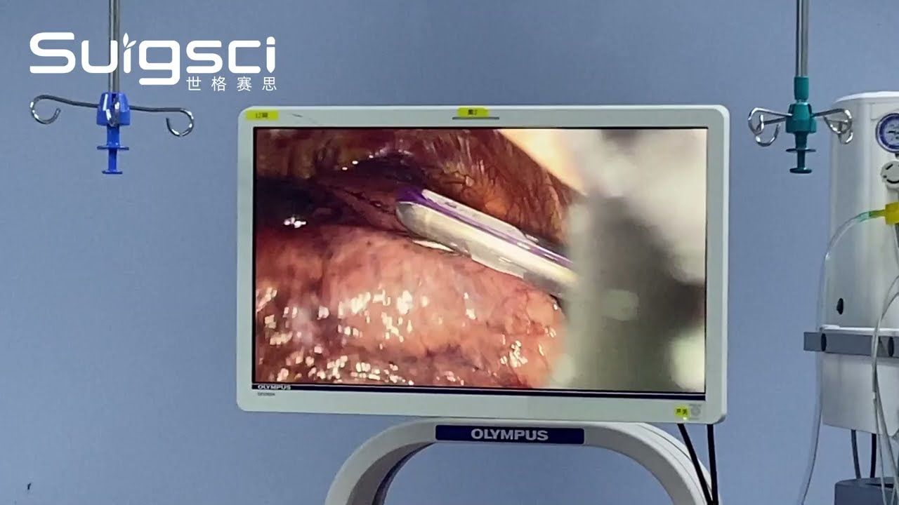Linear Cutter Stapler in Surgical Procedures