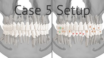 Maestro 3D aligners virtual setup: case 5, crowding with HUGE roots