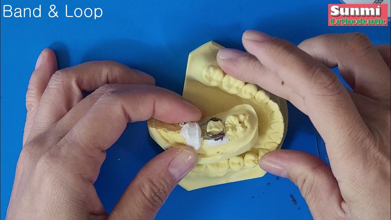 공간유지장치 밴드앤루프 Band & Loop space maintainer YouTube