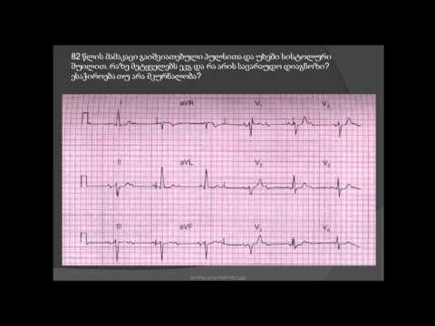 ეკგ / ბიფასციკულური ბლოკადა / მეორე ხარისხის ავ ბლოკადა / aortuli stenozi / sistoluri shuili / PQi