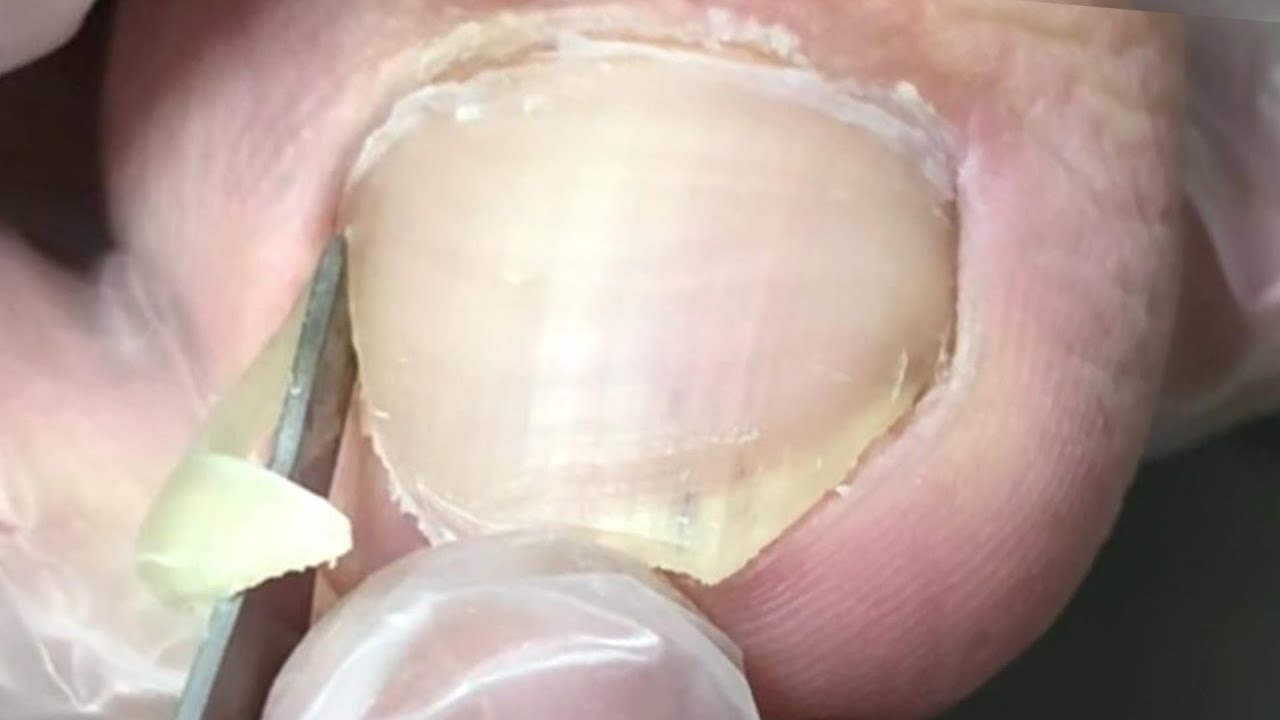PEDICURE INGROWN nails, digging out and leaving holes!【DrZhang】 YouTube