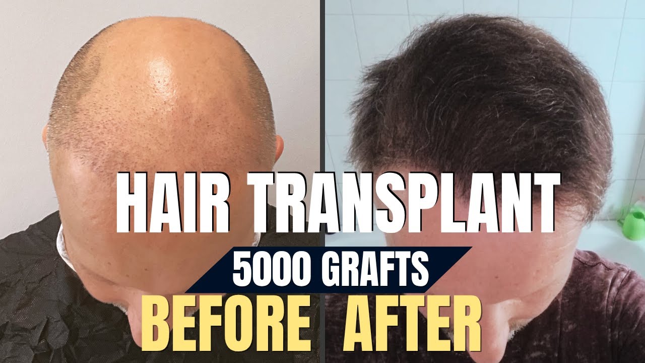 Пересадка волос 5000 графтов до и после l Пересадка волос в Турции