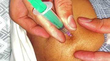 Intramuscular injection use ll I’m injection lagana sikhe