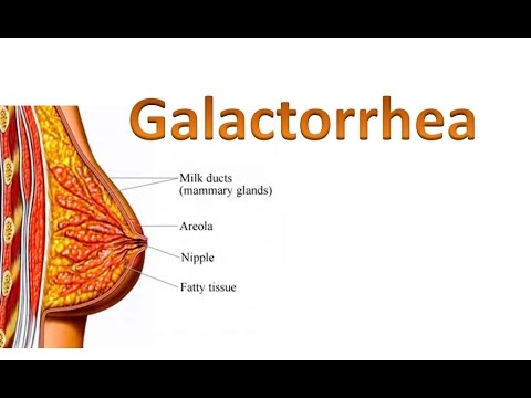 Video: Galactorrhea: Příznaky, Příčiny U Mužů A žen A Léčba