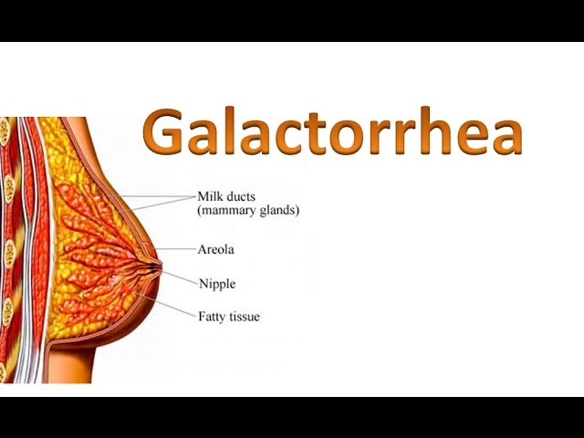 Galactorrhea - YouTube