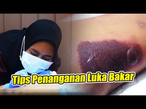 Video: Mengapa Anda melakukan debridement pada luka bakar?