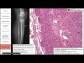 Bone and cartilage tumors