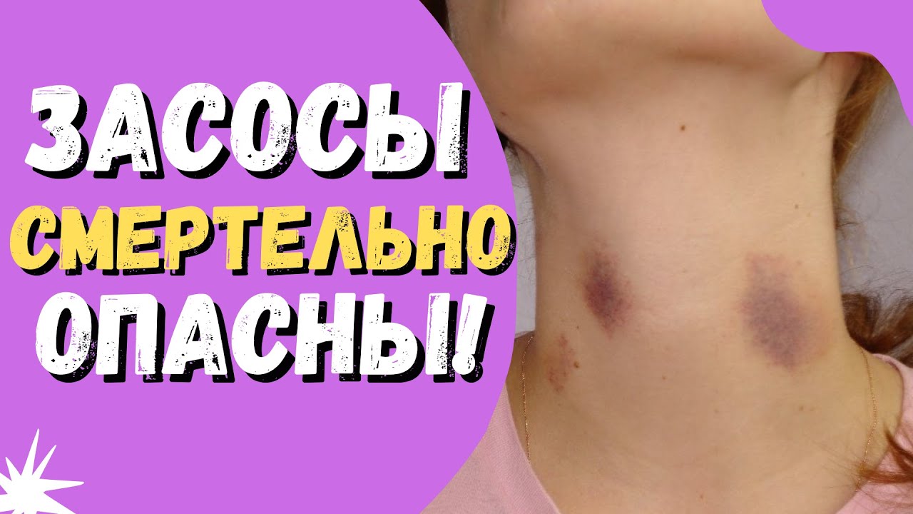 Чем опасны засосы? Будьте осторожны! - YouTube