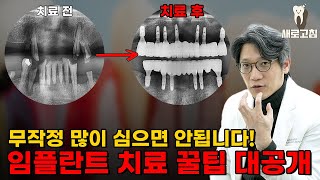 임플란트를 오래 쓸 수 있는 치료법 이게 제일 중요합니다! ㅣ 60대 환자 전체 임플란트 사례