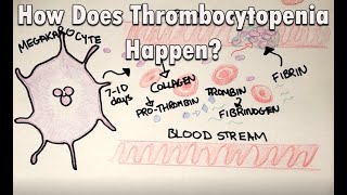 How does thrombocytopenia happen | Low platelets and the COVID vaccine