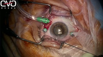 EVA NEXUS™ and EVA INICIO™