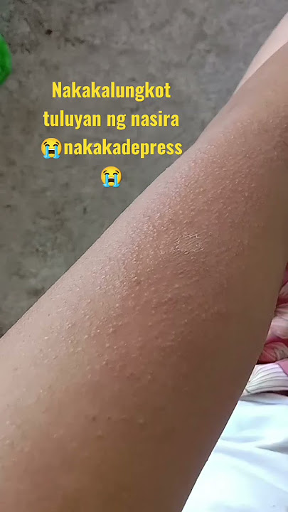 Skin rashes attack super depressed 😭#shorts #youtubeshorts #health #skincare #fyp