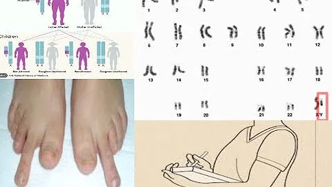 mixed gonadal dysgenesis  signs and symptoms & treatment