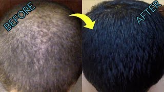 100% of balding men need to try this ...