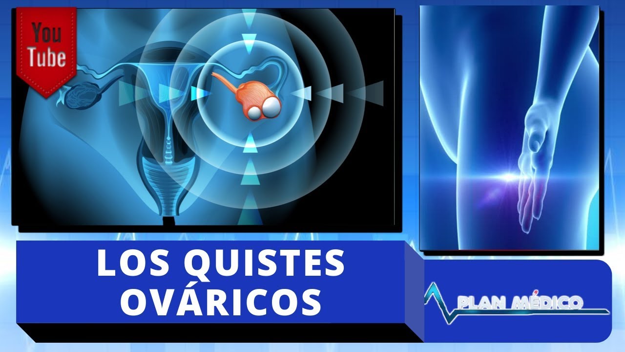quistes ováricos causan dolor pélvico