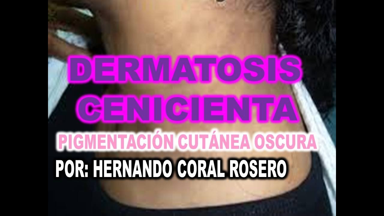 DERMATOSIS CENICIENTA O ERITEMA DISCROMICO PERSTANS ( PIGMENTACIÓN CUTÁNEA  OSCURA ) - YouTube