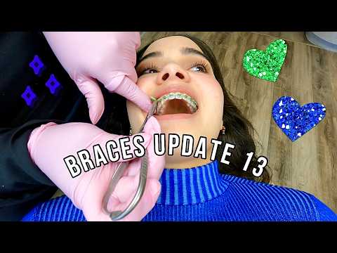 Braces Update 13 🦷 (Over one year with braces, wire through molar brackets, new wire, green bands)