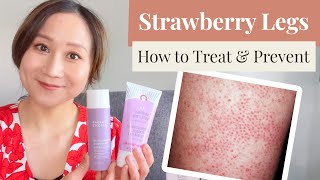 STRAWBERRY LEGS - Get Rid of Them and Prevent Them Like a Dermatologist