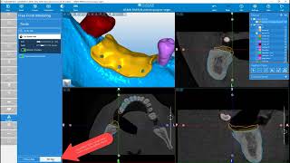 RealGUIDE Software:  Volume Contact Surface