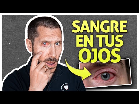 Vídeo: Si El Ojo Se Pone Rojo, ¿qué Hacer? El Ojo Del Niño Se Puso Rojo