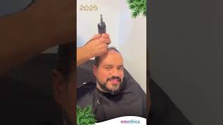 Hair Transplant FUE in Istanbul Turkey