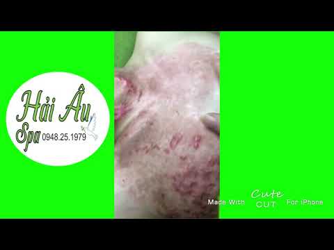 Video Ca bỏng nặng nhất tại Spa Hải Âu - youtube