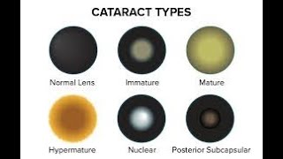 Cataract : Facilitated by Dr. Farotimi .P. Josephine