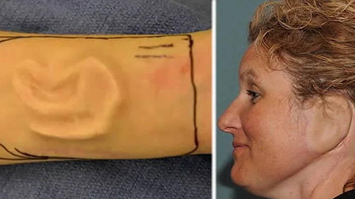 Woman Grows Ear On Her Arm