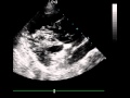 Echocardiogram from a dog with caval syndrome (heartworm)