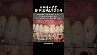 타 치과 교정 중 앞니치료 받으러 온 환자