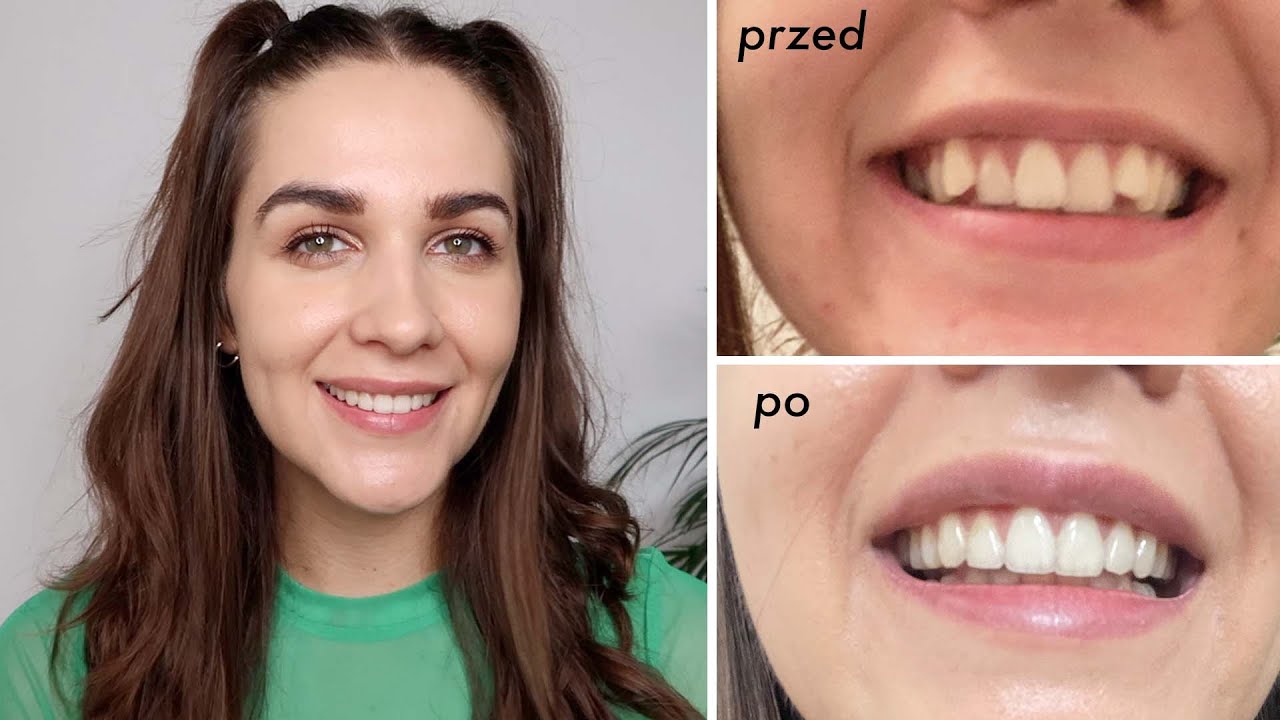 INVISALIGN  🦷 wszystko co musisz wiedzieć o nakładach prostujących zęby | cena, przed i po