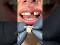 Capture de la vidéo Solution With Flexible Dental Prosthesis Of 1 Tooth #Mrdent #Dentist #Smile #Protesisdental #Viral #