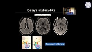 Neuroimaging in oncologic treatment complications Part II