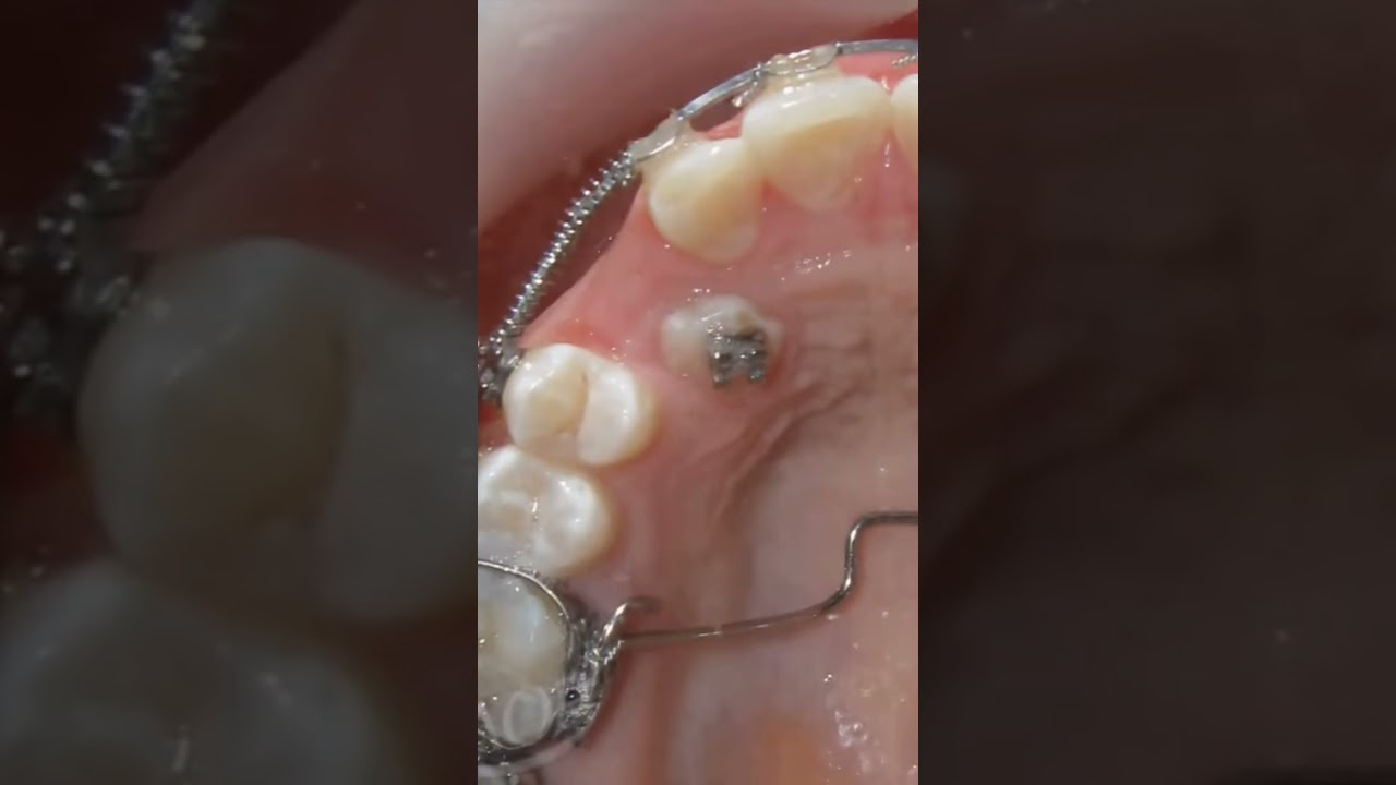 #orthodontics #orthodontictreatment #beforeandafter #braces