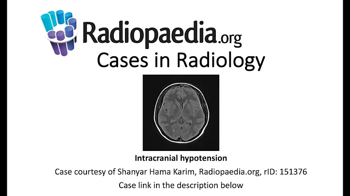 Intracranial hypotension (Radiopaedia.org) Cases in Radiology