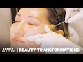 How Nonsurgical Face-Lifts Work With PDO Threads | Beauty Transformations