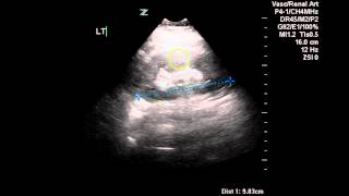 Normal Renal Arterial Doppler - Case Study