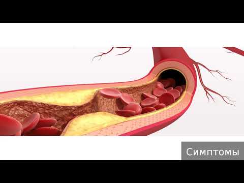 Атеросклеротическая болезнь сердца. Как лечить атеросклеротическую болезнь сердца.