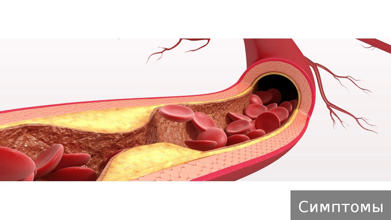 Заболевание атеросклероз. Атеросклероз атеросклеротический кардиосклероз. ИБС атеросклеротический кардиосклероз. Что такое атеросклеротич кардиосклероз?. Атеросклеротическая болезнь болезнь сердца.